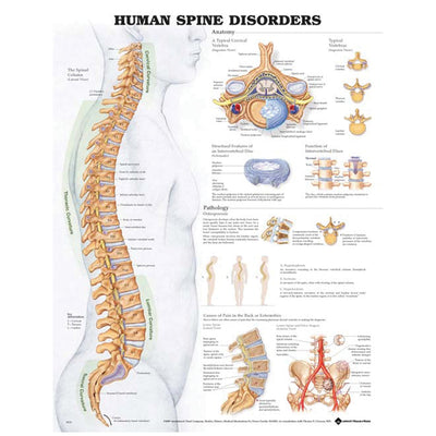 Anatomical Charts & Posters - Human Spine Disorders